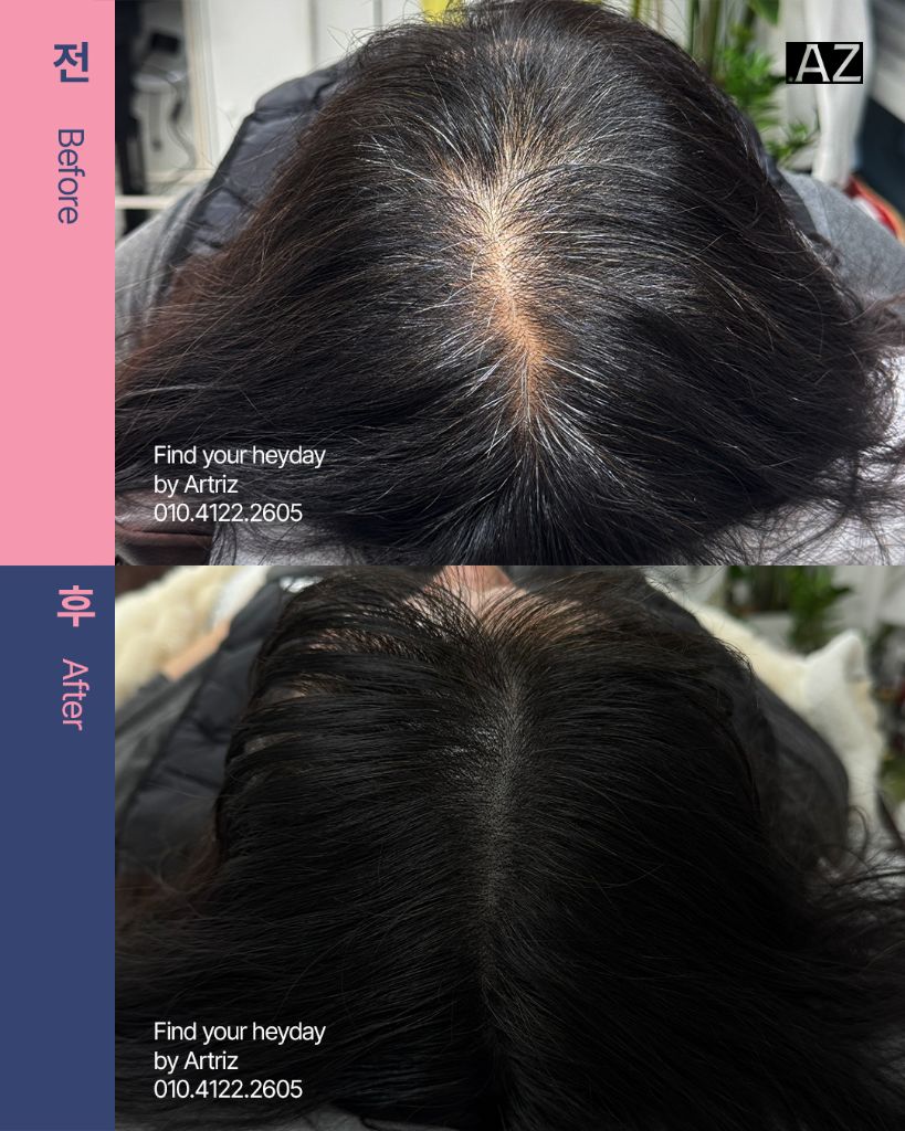 가르마 정수리 두피문신 before after