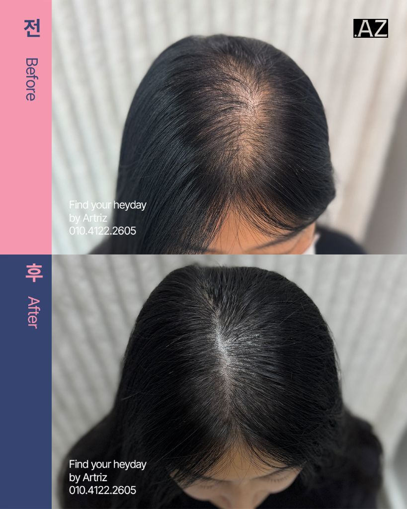 가르마 정수리 두피문신 before after