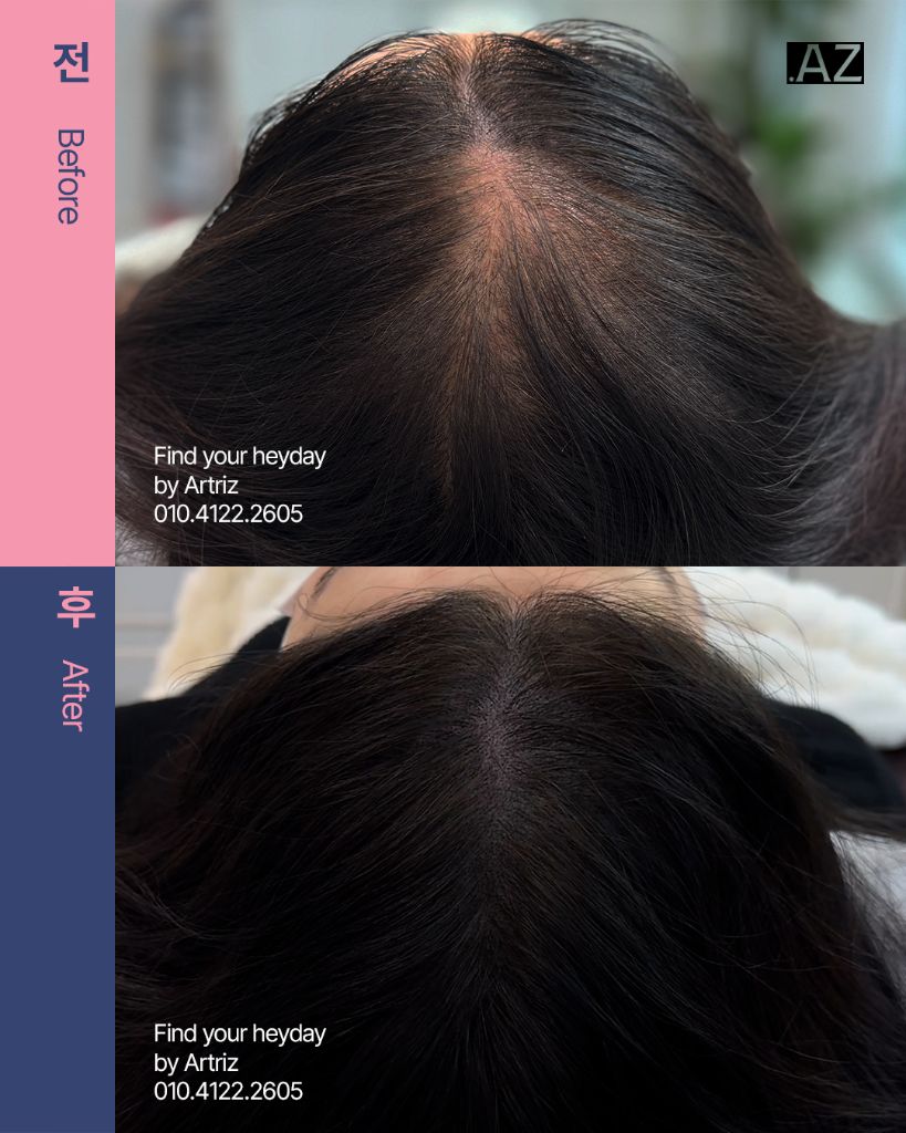 가르마 정수리 두피문신 before after