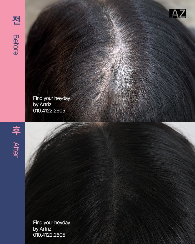 가르마 정수리 두피문신 before after