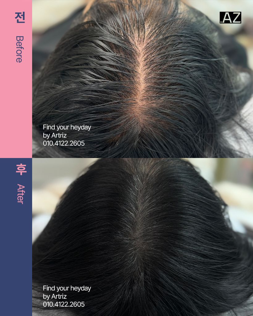 가르마 정수리 두피문신 before after