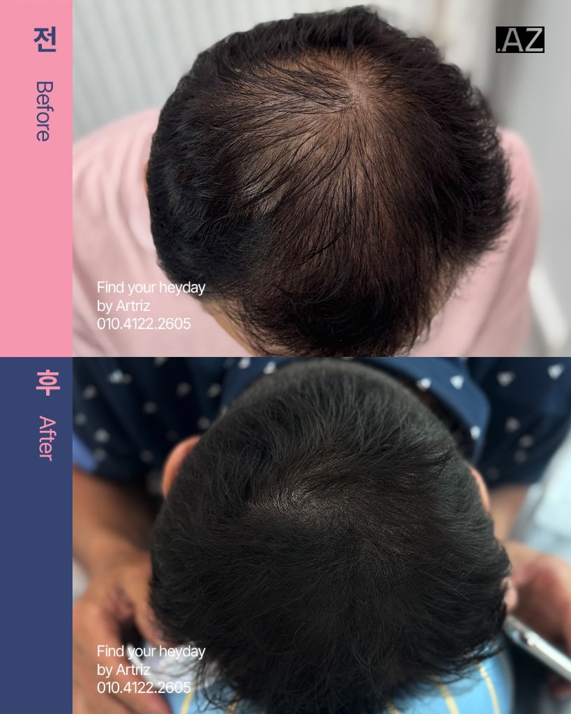 가르마 정수리 두피문신 before after