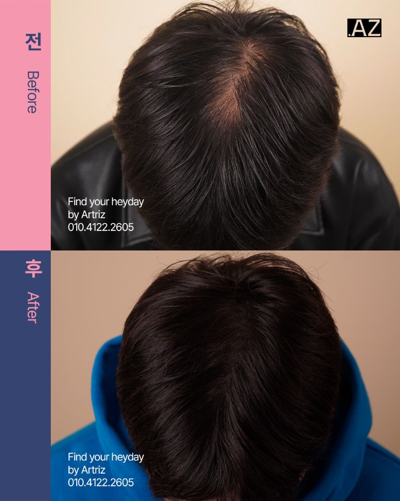 가르마 정수리 두피문신 before after