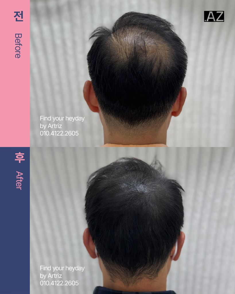 가르마 정수리 두피문신 before after