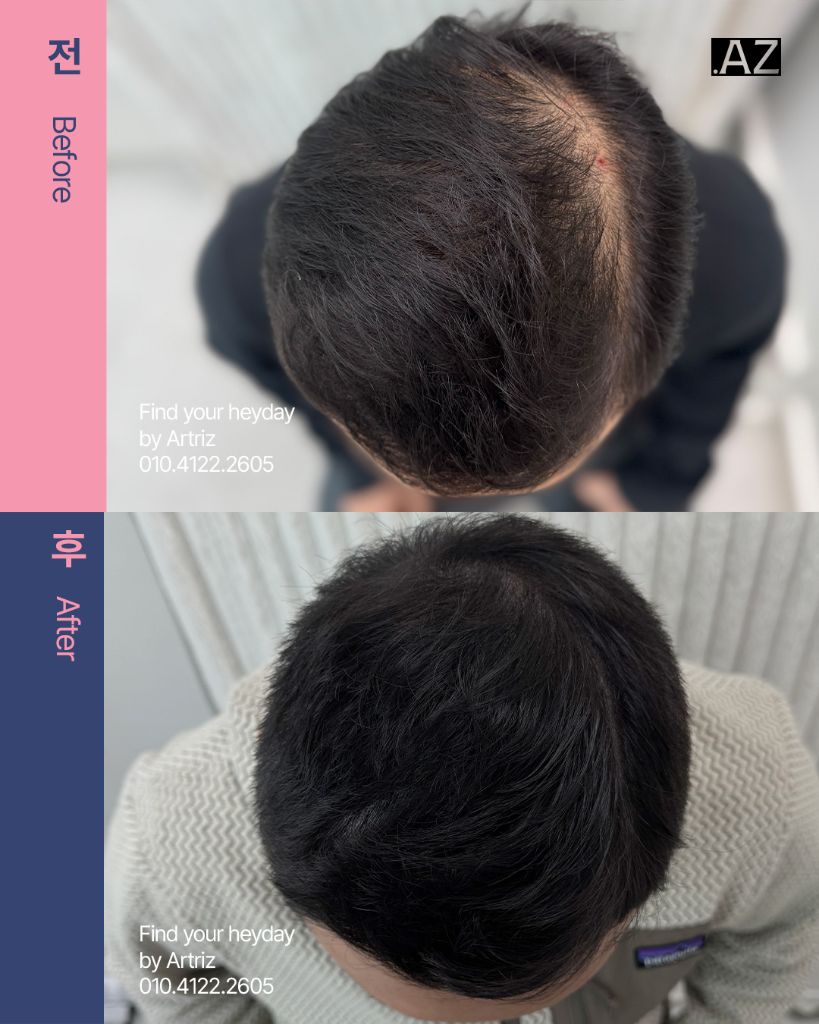 가르마 정수리 두피문신 before after