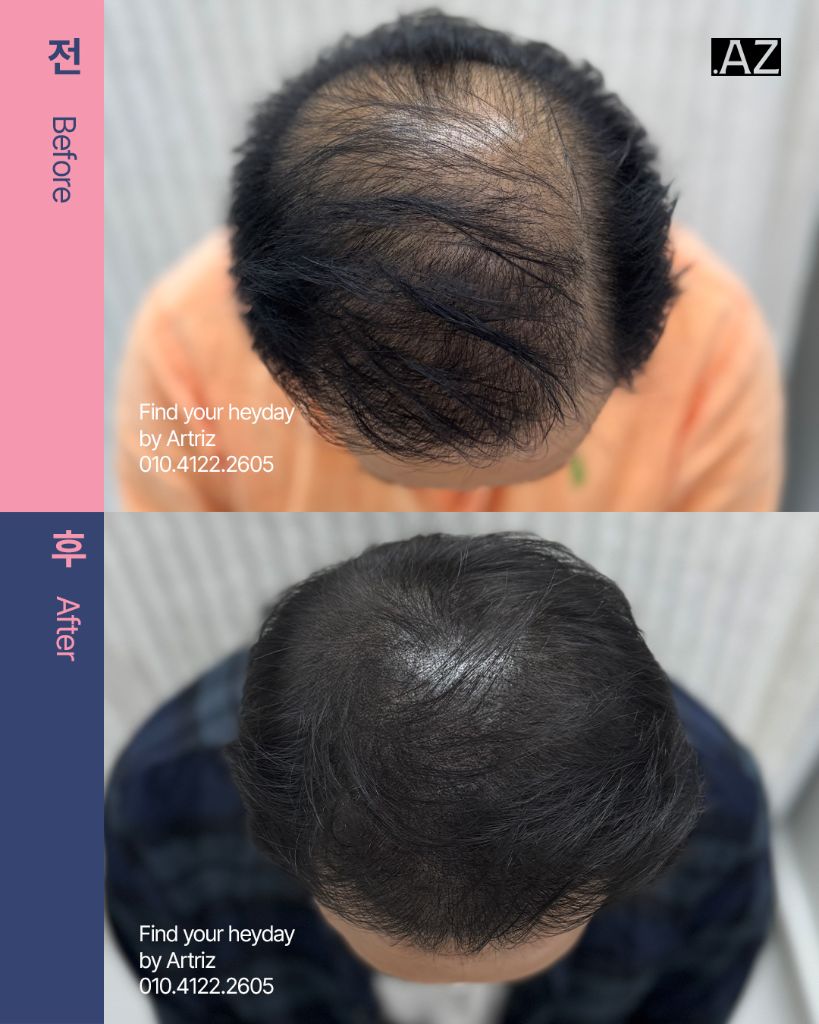 가르마 정수리 두피문신 before after