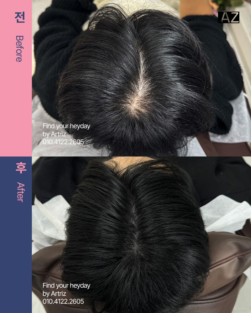 가르마 정수리 두피문신 before after