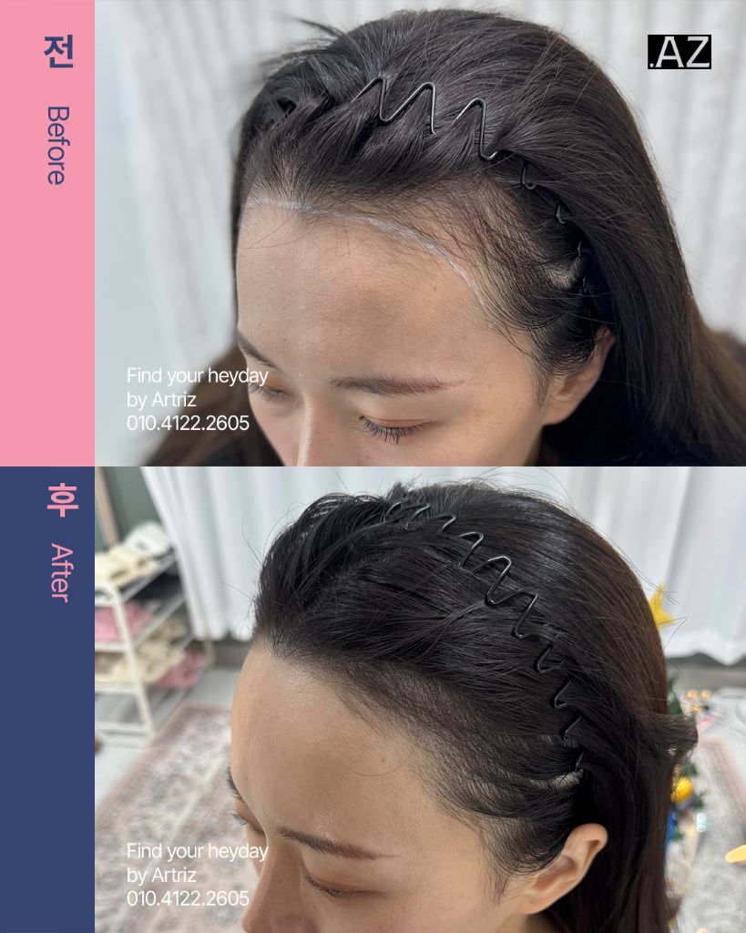여성 헤어라인 두피문신 before after