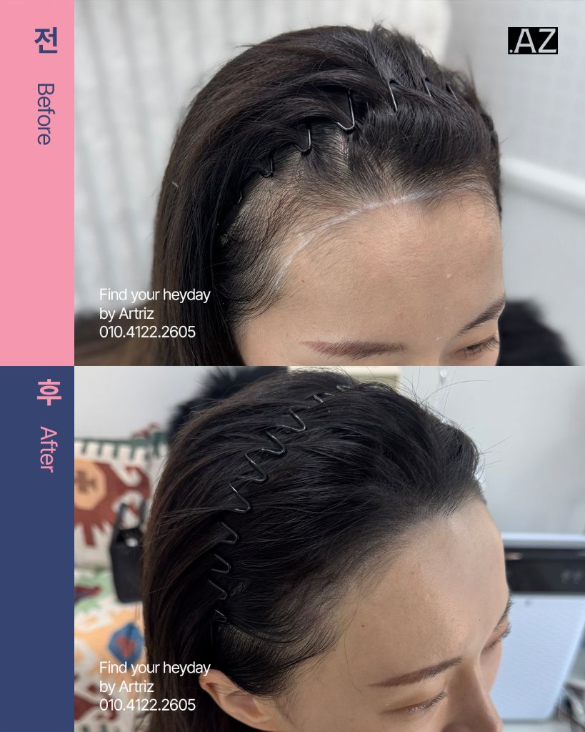 여성 헤어라인 두피문신 before after