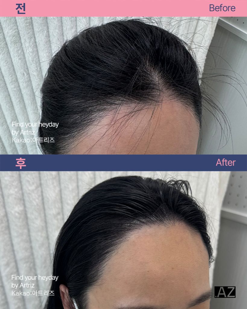 여성 헤어라인 두피문신 before after