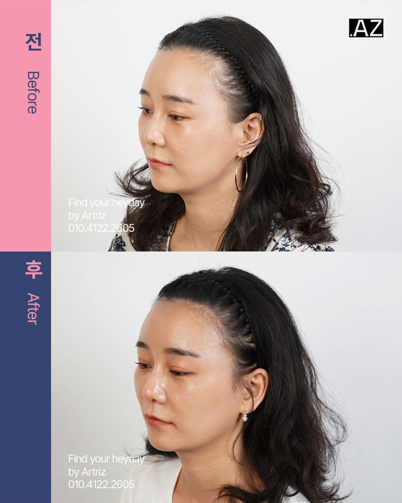 여성 헤어라인 두피문신 before after