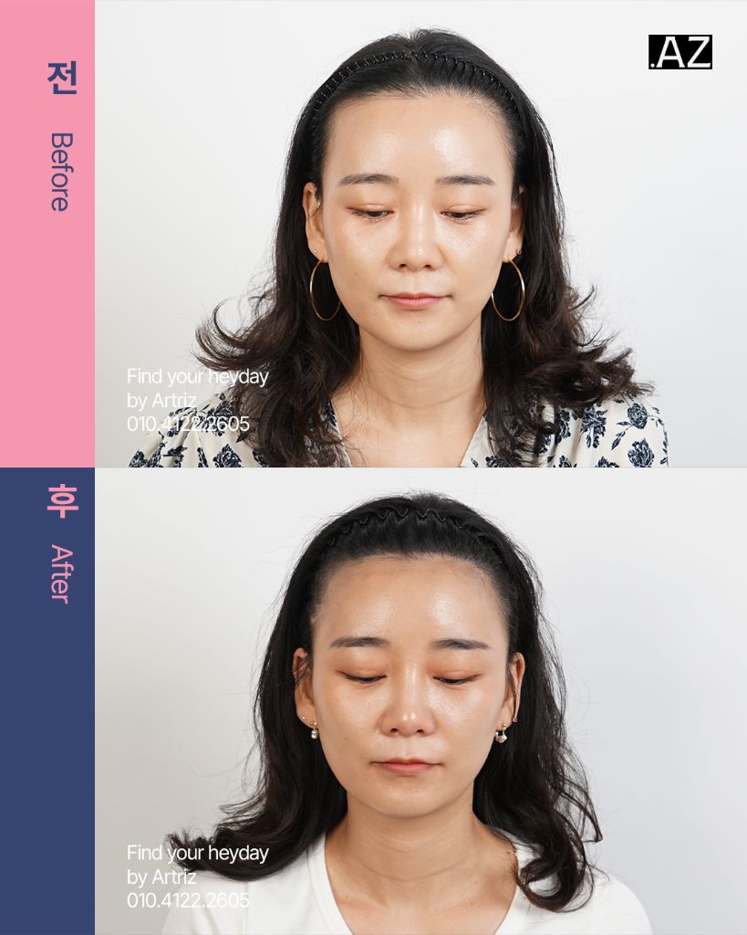 여성 헤어라인 두피문신 before after
