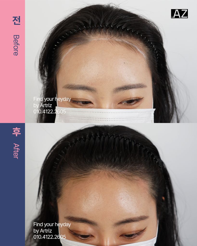 여성 헤어라인 두피문신 before after