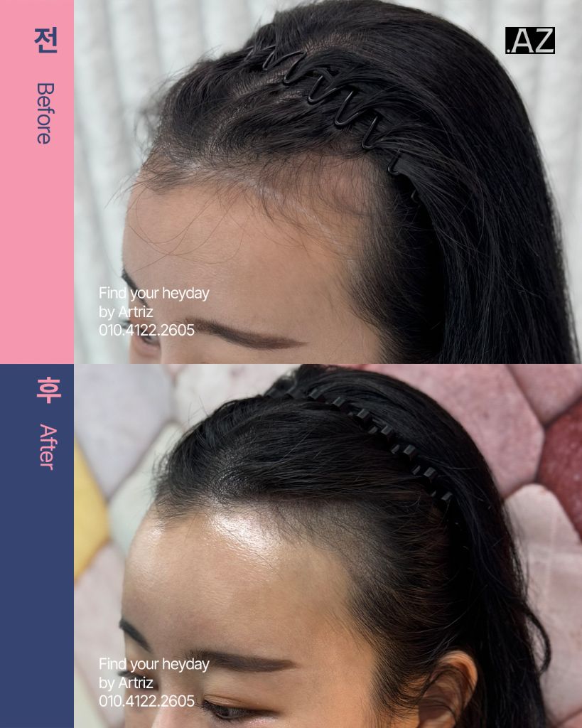 여성 헤어라인 두피문신 before after