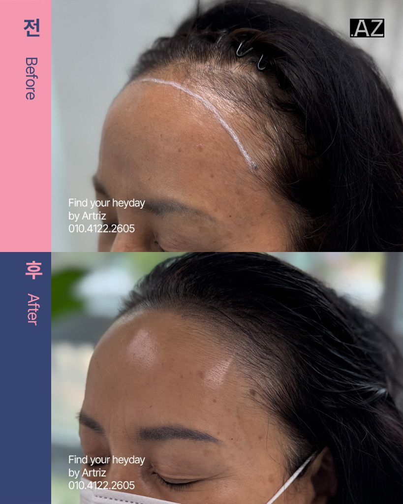 여성 헤어라인 두피문신 before after