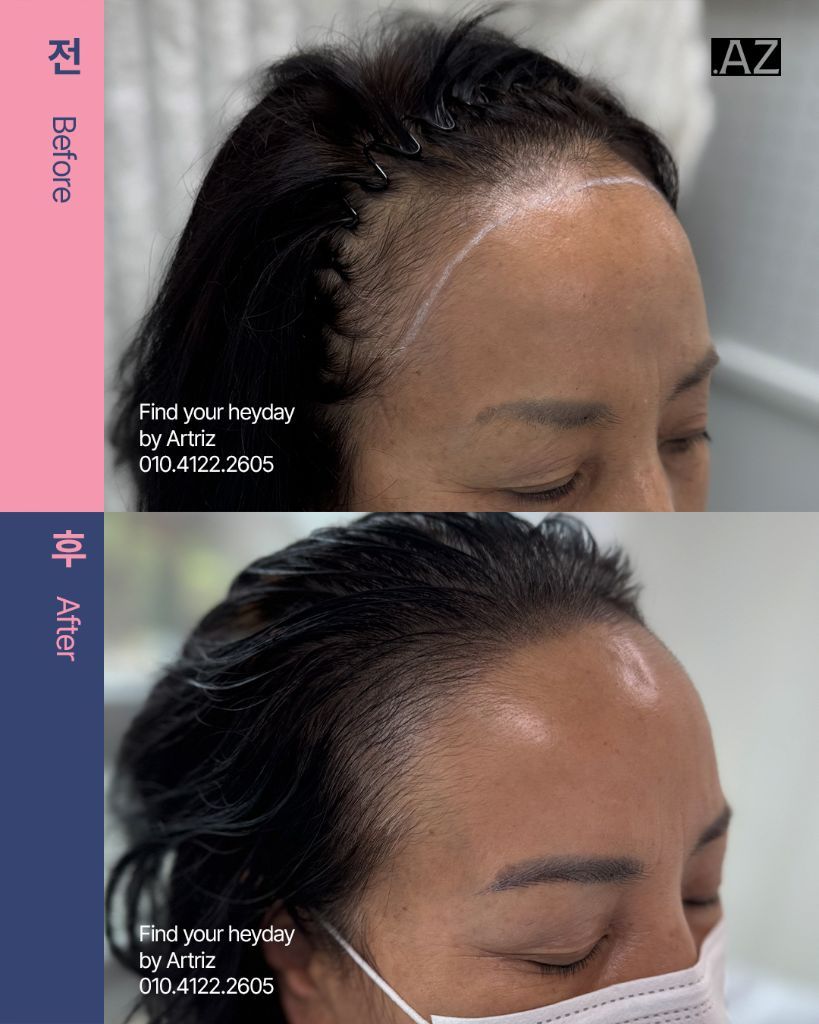 여성 헤어라인 두피문신 before after