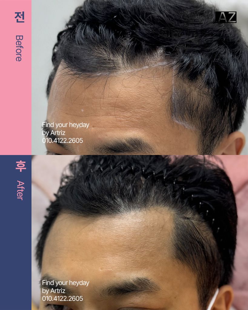 남성 헤어라인 두피문신 before after