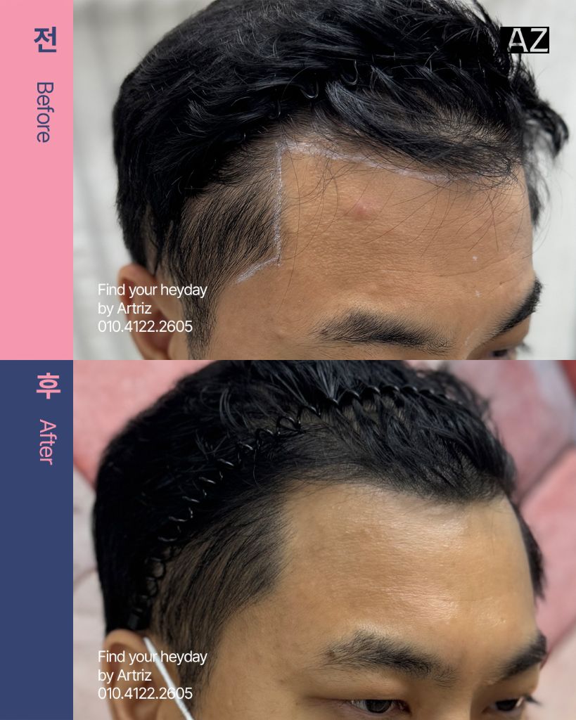 남성 헤어라인 두피문신 before after