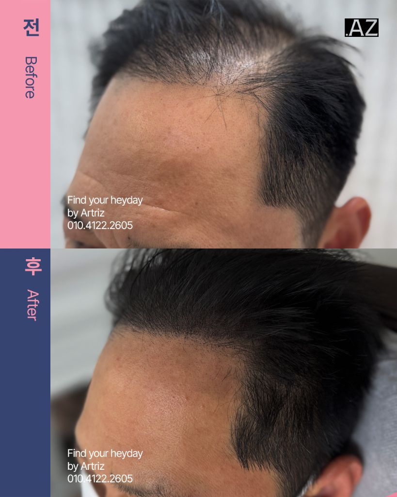 남성 헤어라인 두피문신 before after