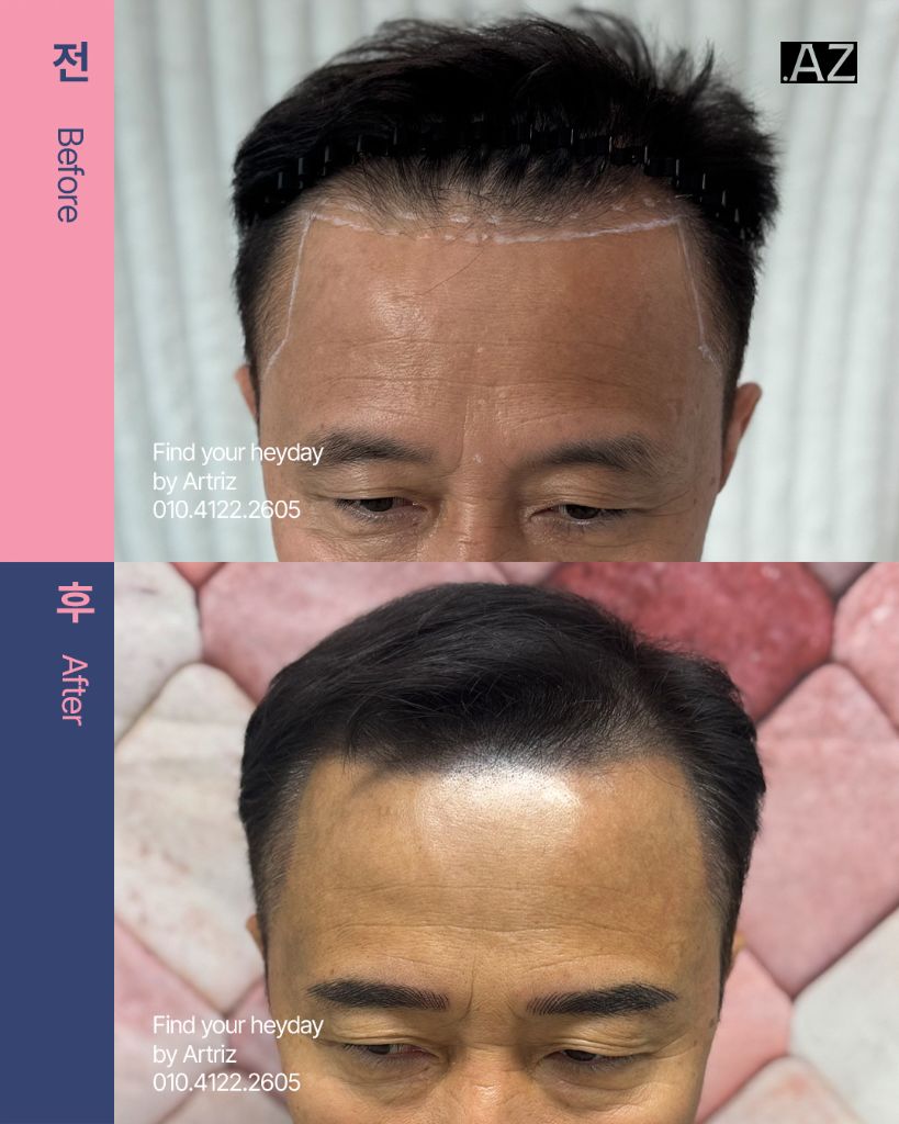 남성 헤어라인 두피문신 before after