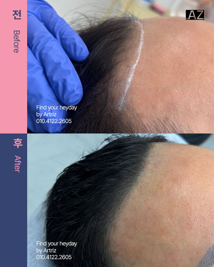 남성 헤어라인 두피문신 before after