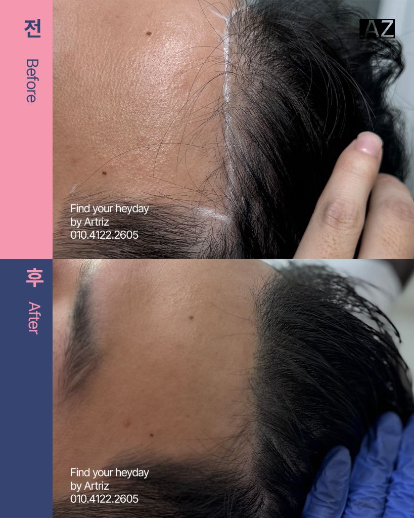남성 헤어라인 두피문신 before after