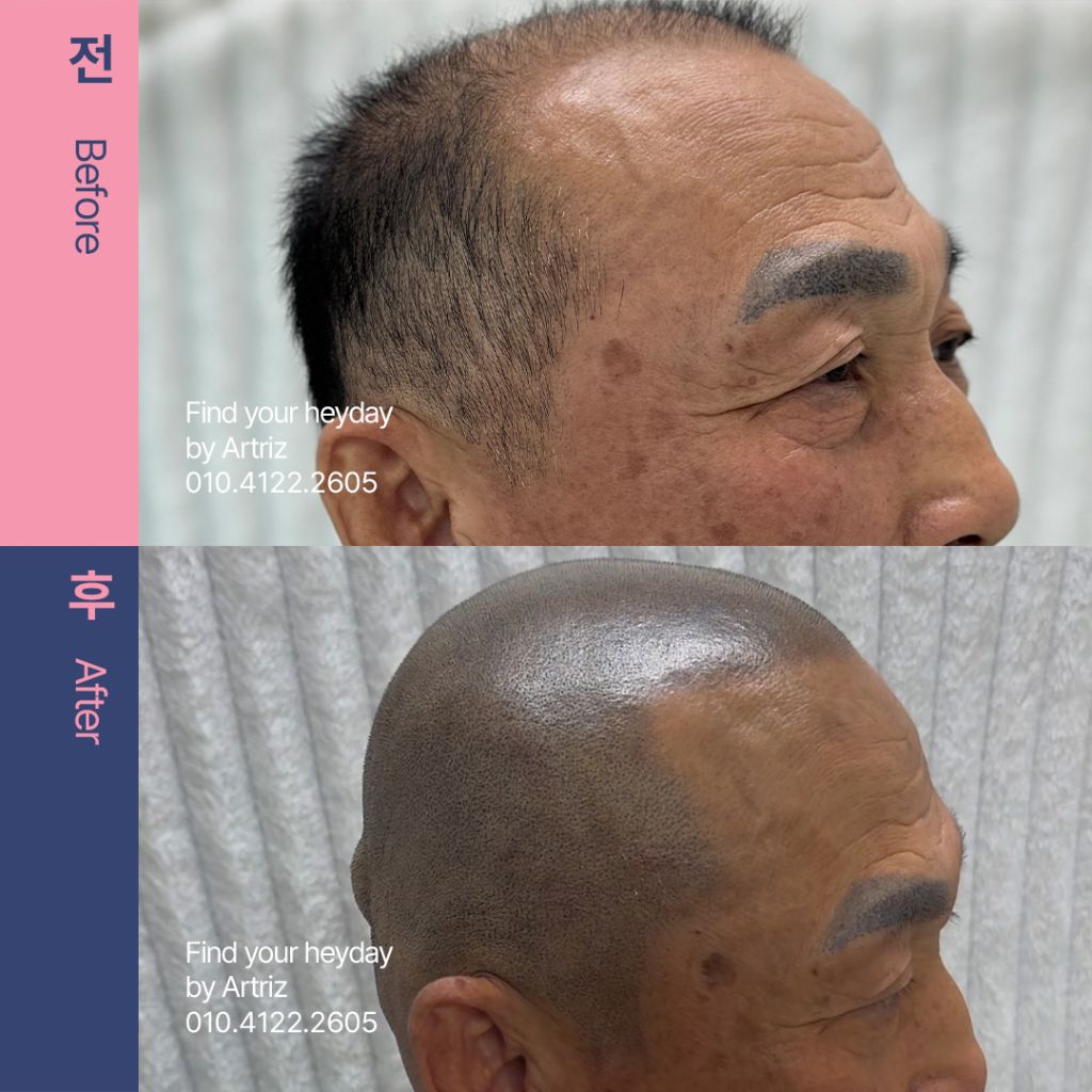 삭발 디자인 두피문신 before after
