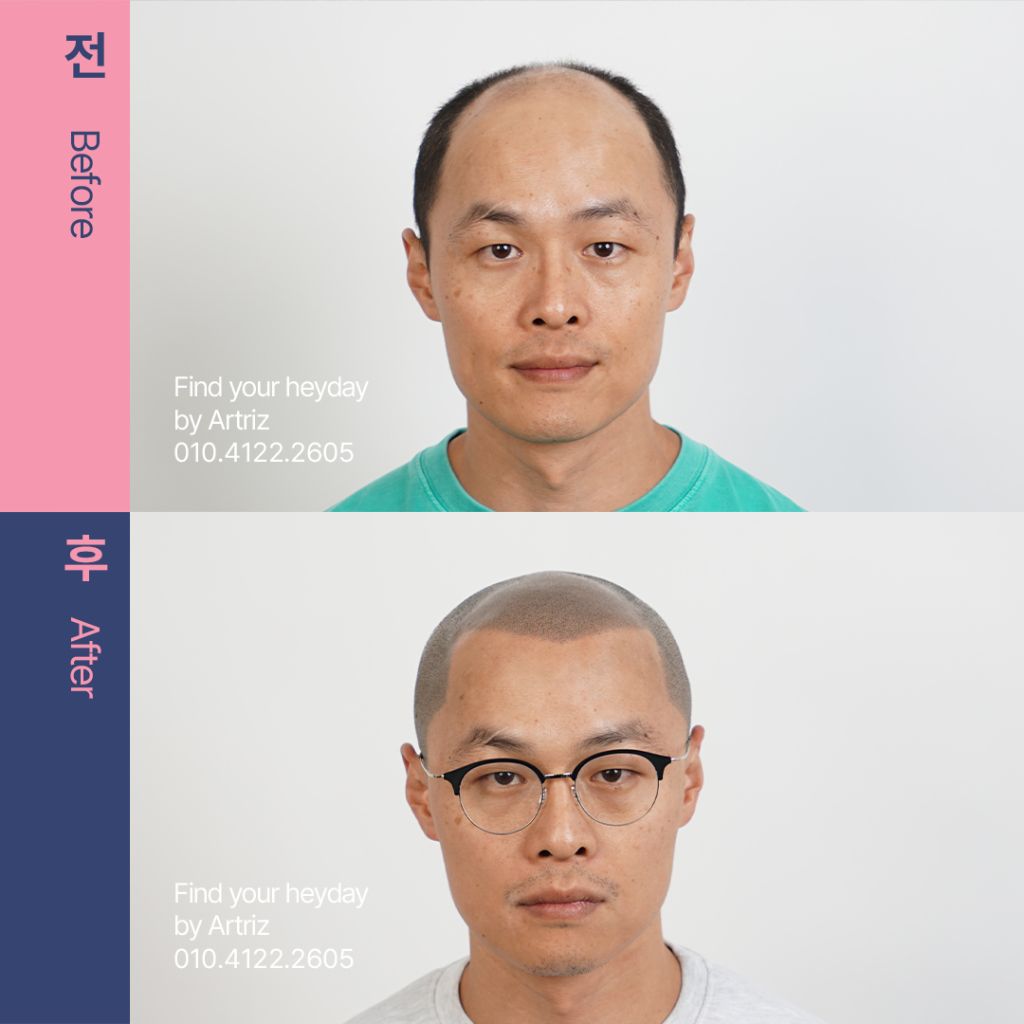 삭발 디자인 두피문신 before after