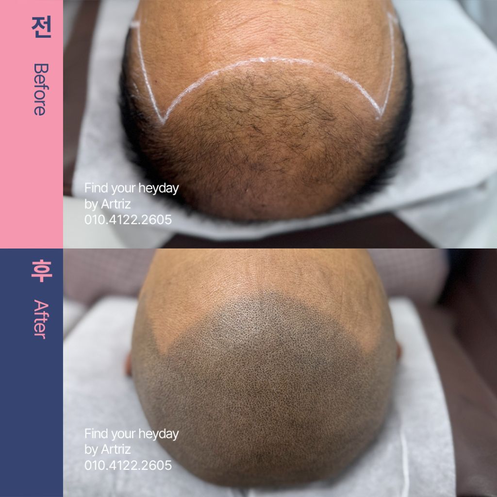 삭발 디자인 두피문신 before after